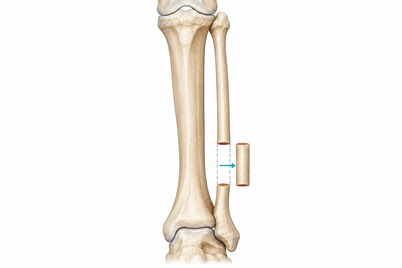 FTT illustration: two complete cuts in the distal third of the fibular shaft isolate a full-width segment, which is moved sideways; the tibia remains intact